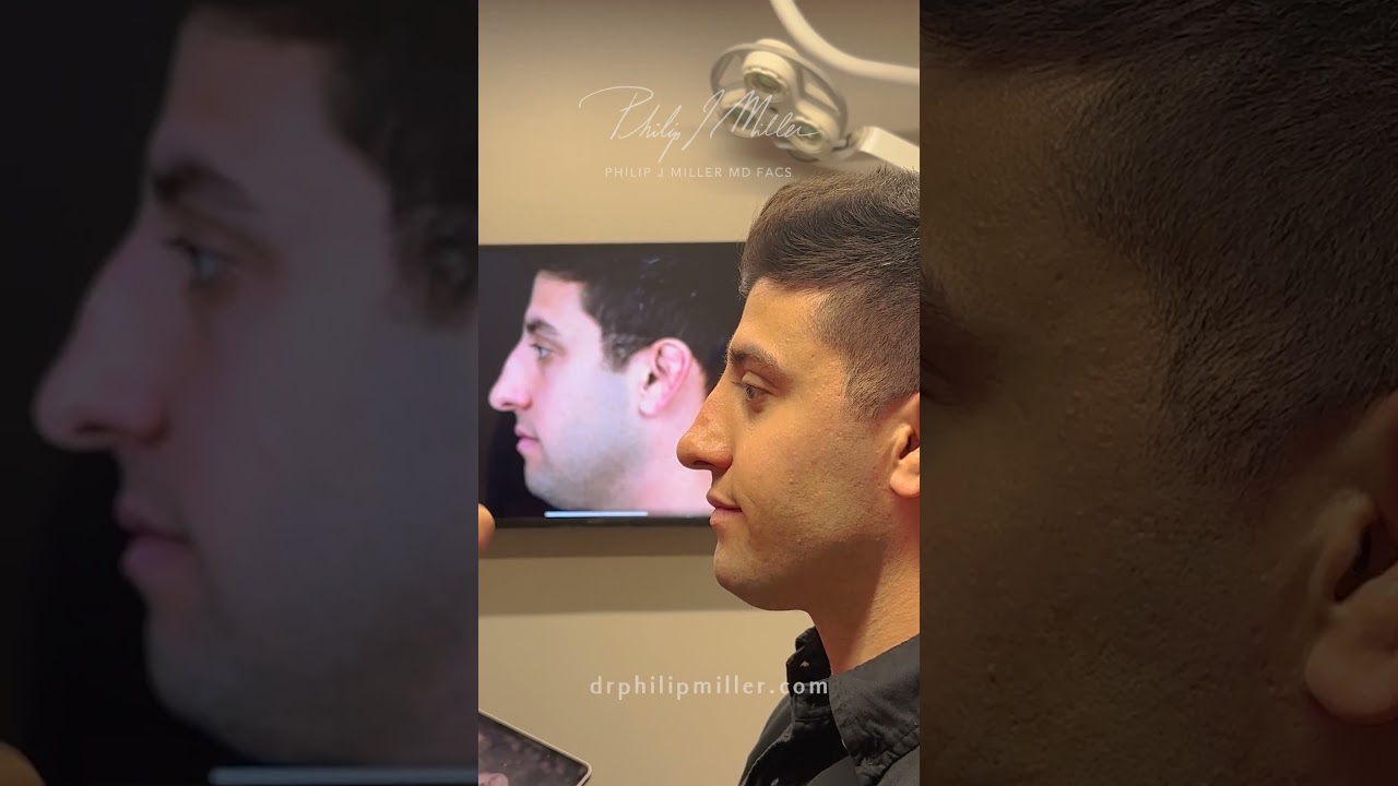 4 Weeks Post Op Rhinoplasty!