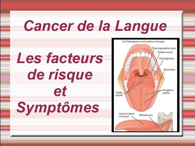 Cancer de la langue : Facteurs de risque et Symptômes - YouTube