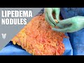 Lipedema nodules discussion  total lipedema care