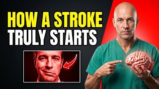 What a Stroke Looks Like 24 Hours Before It Hits — Know This to Protect Yourself
