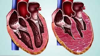 Miocardiopatia Hipertrófica
