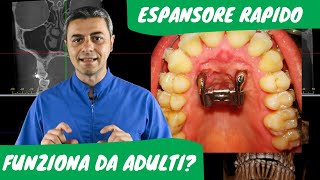 Espansore rapido da ADULTI: funziona?