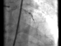 Rotablation for calcified lad coronary artery stenosis
