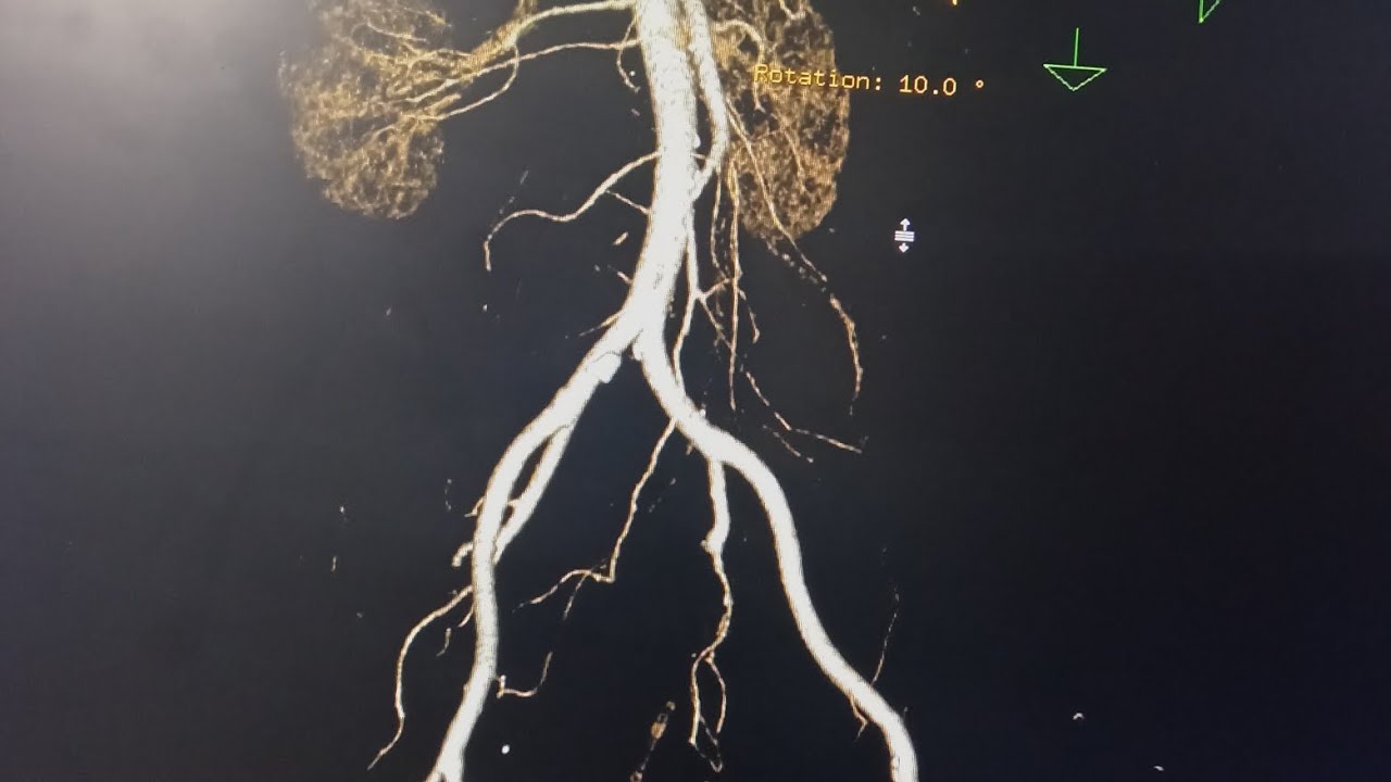 CT Abdomen angio post processing filming - YouTube
