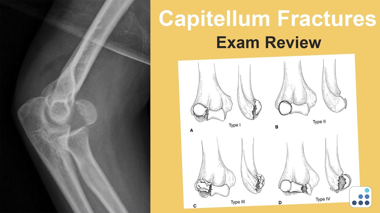 Capitellum Fractures Exam Review - Joaquin Sanchez-Sotelo, MD - YouTube