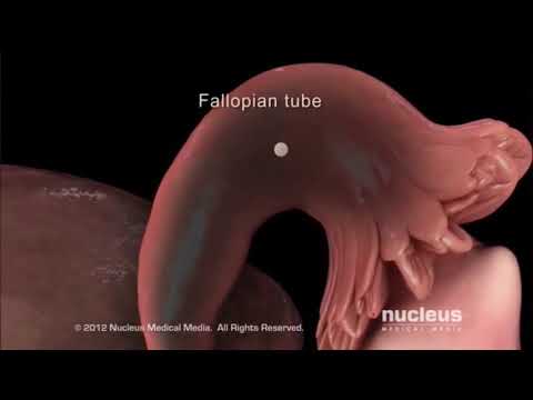 Vidéo: Kyste De L'ovaire Endométrioïde - Causes, Signes Et Symptômes D'un Kyste Endométrioïde De L'ovaire Gauche Et Droit, Laparoscopie