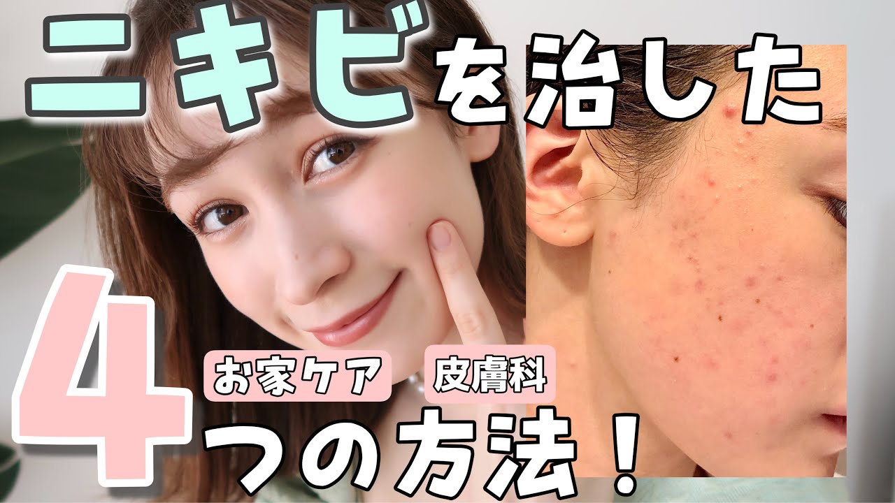 ニキビ撃退法 今日からできるお家ケアから実際に通った皮膚科まで 芸能人youtubeまとめ