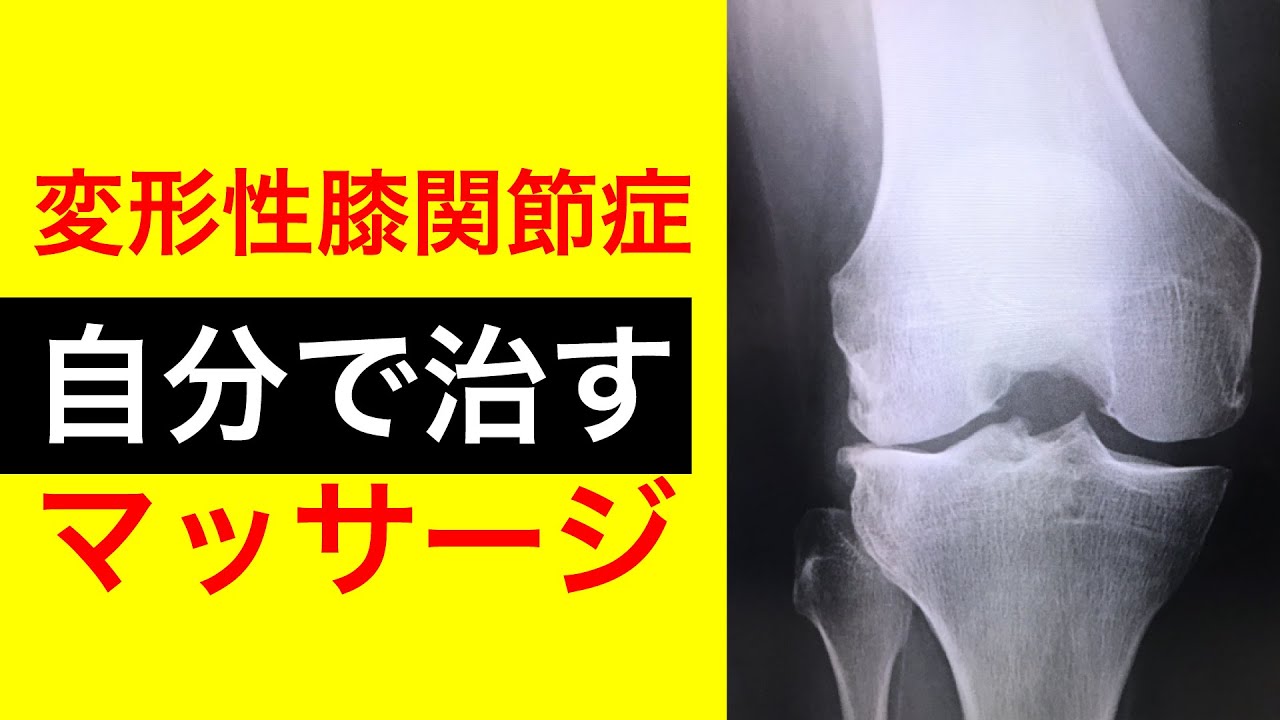 【9割が効果あり】変形性膝関節症の痛みを自分で治す方法