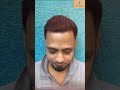 A life changing experience | Hair Transplant by Dr Jangid | #Shorts
