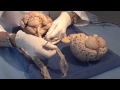Three Critical Vertical Pathways: Neuroanatomy Video Lab - Brain Dissections