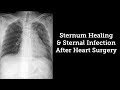 Sternum Healing & Sternal Infection Rates After Heart Surgery with Dr. Steve Bolling