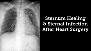 Sternum Healing & Sternal Infection Rates After Heart Surgery with Dr. Steve Bolling