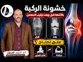 خشونة الركبة بالأشعة قبل وبعد تركيب المفصل | متى تحتاج علاج طبيعي ومتى الجراحة؟