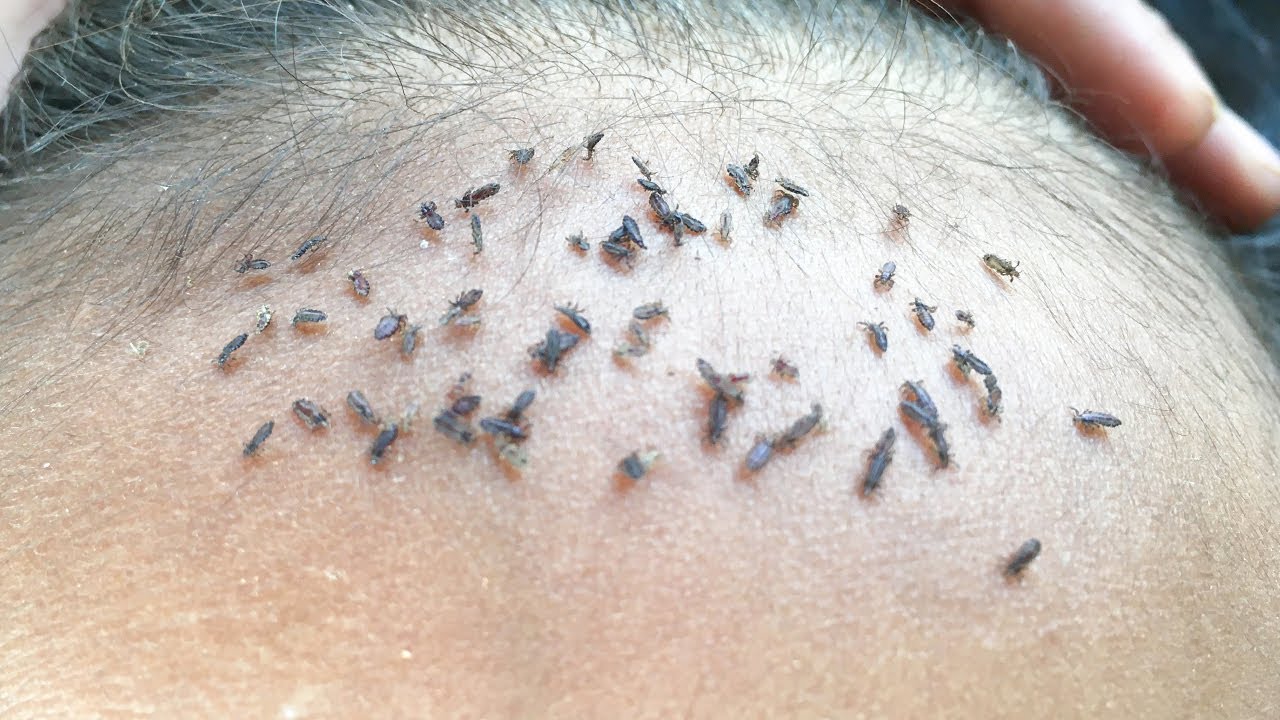 Remove All Lice From Long Hair & Black Hair Picking Out All Lice From