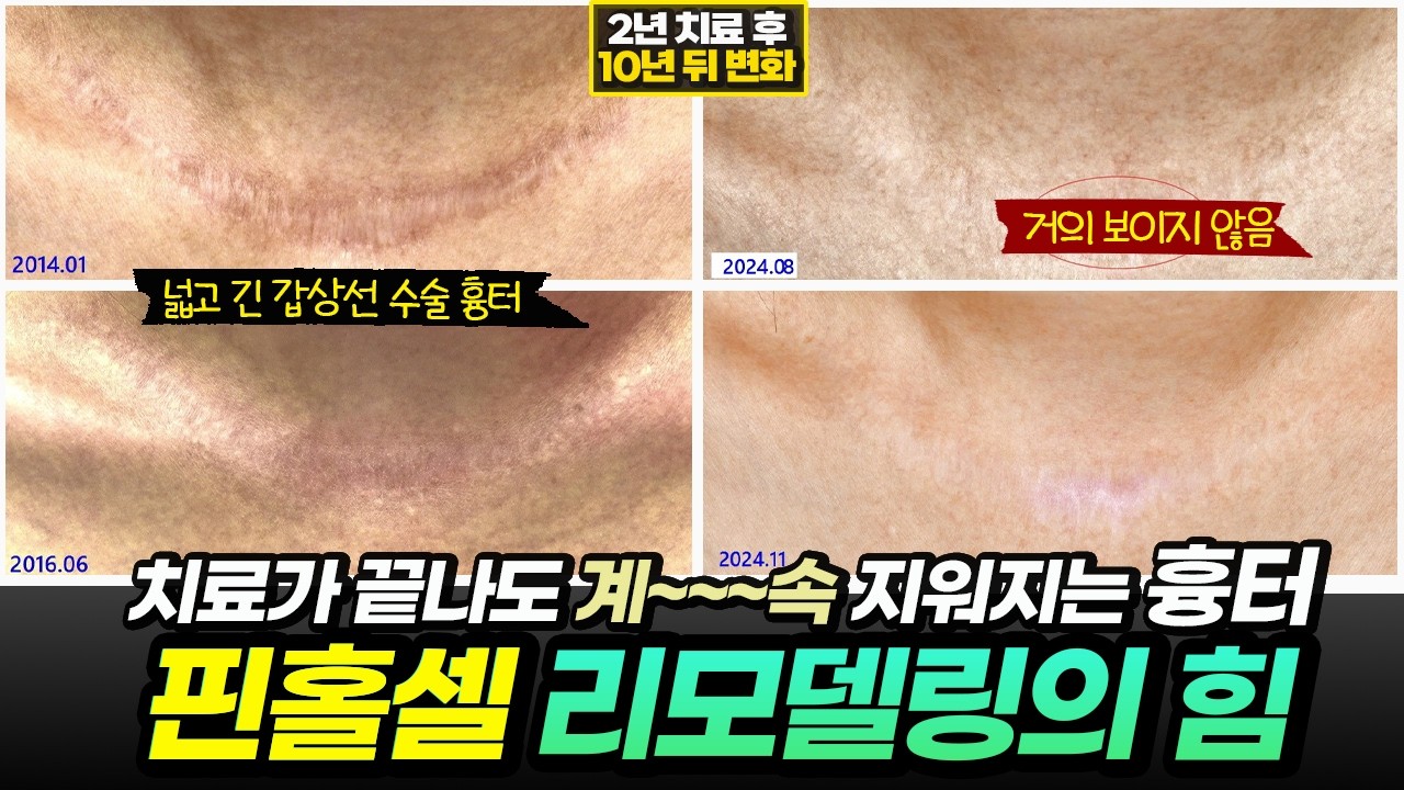 갑상선암 수술 흉터로 보는 핀홀셀 리모델링의 놀라운 재생 효과????