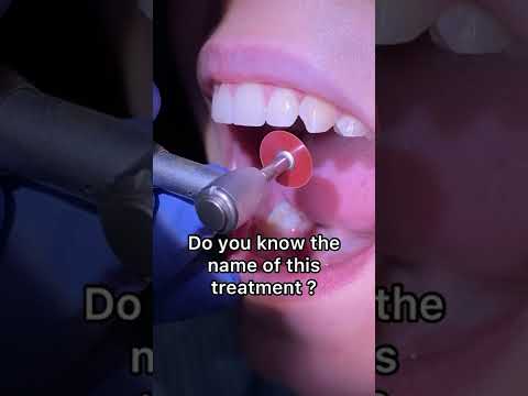 Video: Apa itu odontoplasti gigi?