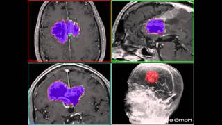Semi-Automatic Medical Image Segmentation