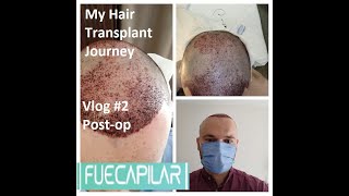 My Hair Transplant Journey - Fuecapilar, Dr. Turan, Istanbul. Vlog Post-Op.
