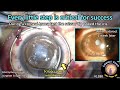 Cataractcoach 1380 every little step of surgery is critical for success