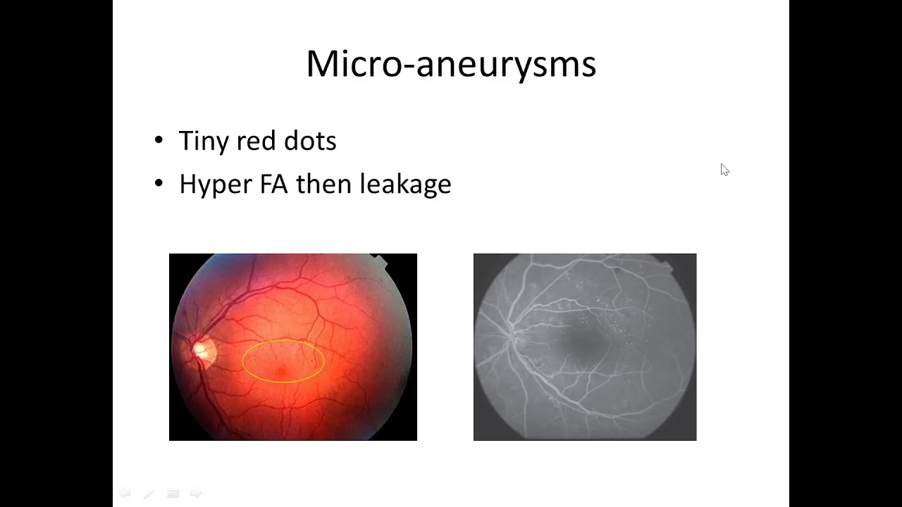 Diabetic retinopathy part 1.