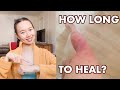 How Long to Heal Eczema