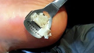 Pedicure [ Hard Dead Skin Removal ]