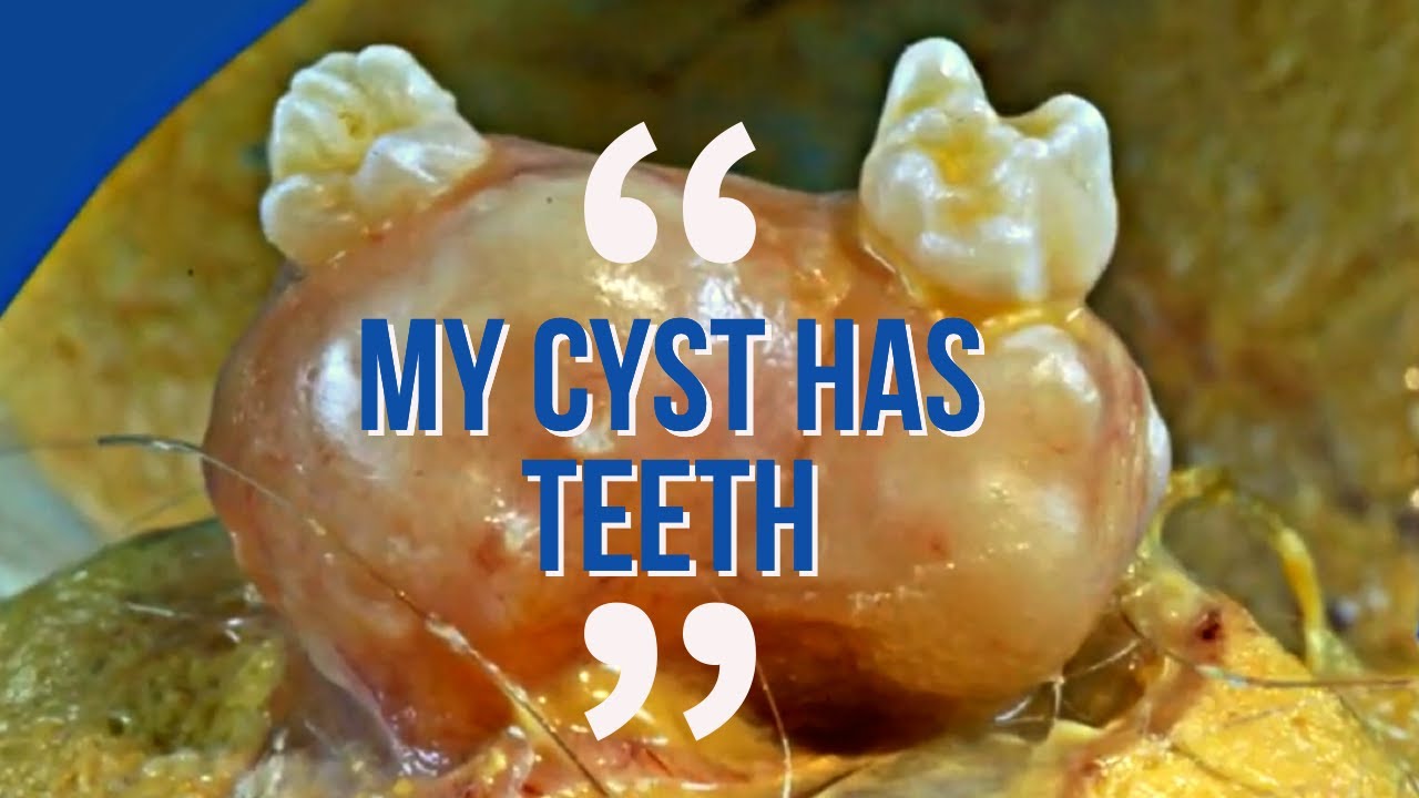 Is This A Record Breaking Dermoid Cyst? Dermoid Cysts Case Study | Cyst  Grows Hair And Teeth - thptnganamst.edu.vn