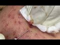 Big cystic acne blackheads extraction blackheads  milia whiteheads removal pimple popping