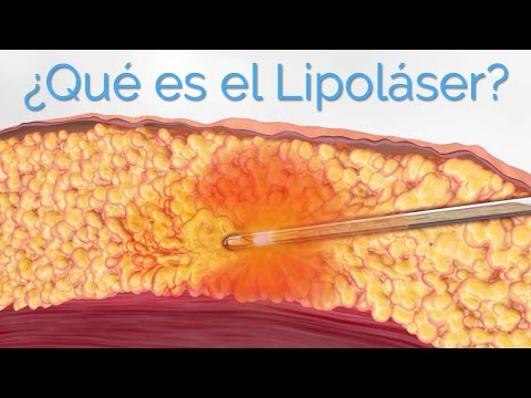 Liposucción Láser ¿Qué es el Lipoláser y Para Qué Sirve?