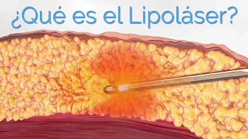 ¿Qué liposucción elimina más grasa?