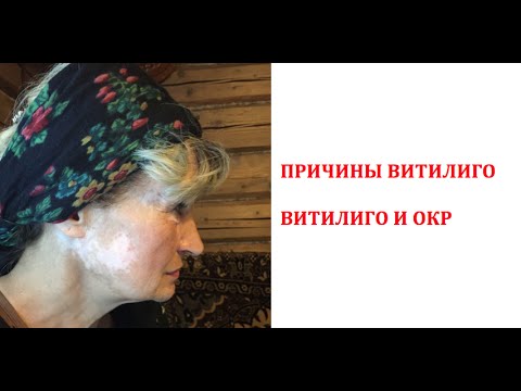 Витилиго причины и лечение. Витилиго и ОКР. Как избавиться от витилиго ...