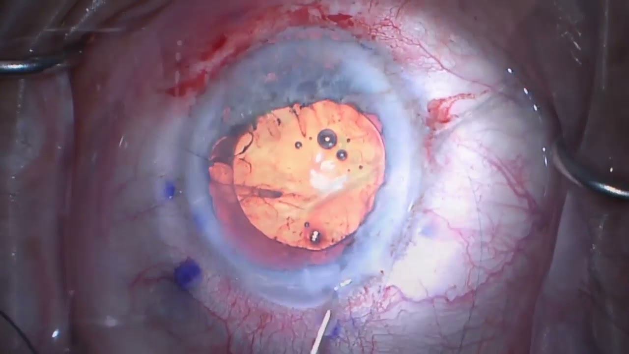 Pupil Cerclage Technique