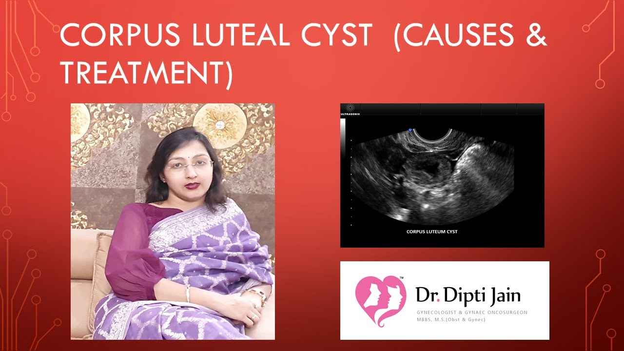 CORPUS LUTEAL CYST - CAUSES & TREATMENT 