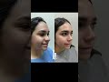 Rinoplastia 15/05/25 Dr Jaimes Antes y después