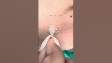 ⚠️Pimple Patch Removal⚠️