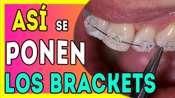 🔴𝗗𝗘𝗦𝗖𝗨𝗕𝗥𝗘 como se 𝗣𝗢𝗡𝗘𝗡 𝐥𝐨𝐬 𝐁𝐑𝐀𝐂𝐊𝐄𝐓𝐒 TRANSPARENTES, 𝙈𝙚𝙩𝙤𝙙𝙤 PROFESIONAL Explicado paso a paso