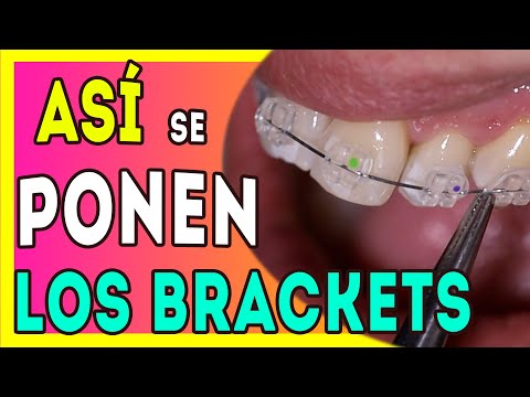 Vídeo: Els braquets poden arreglar les dents atapeïdes?
