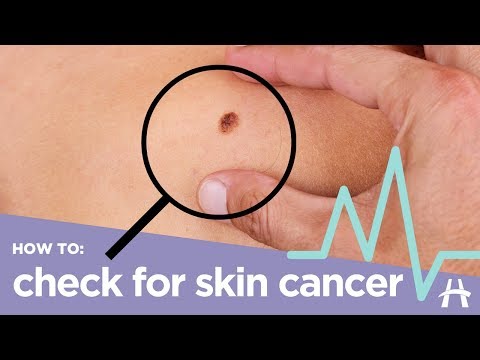 How to check for skin cancer