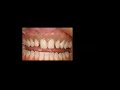 Dental Treatment: Porcelain Veneers Nov 10, 2020