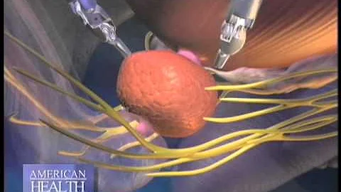 Robotic Prostate Surgery Video
