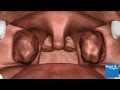 How an adenotonsillectomy is carried out | Bupa Health