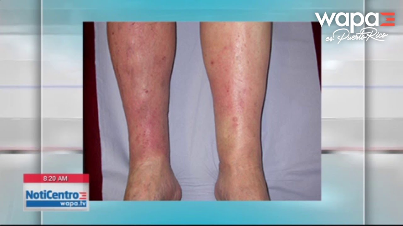 Cuidado y envejecimiento de la piel en el área las piernas | WapaTV - YouTube