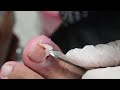 Ep_3678 Big ingrown toenail removal 👣 นั่นแหละพี่..สุดยอดมากครับ 😷 (clip from Thailand)