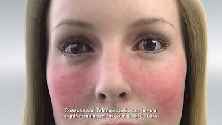 IPL treatment for Rosacea and Dry Eye Disease