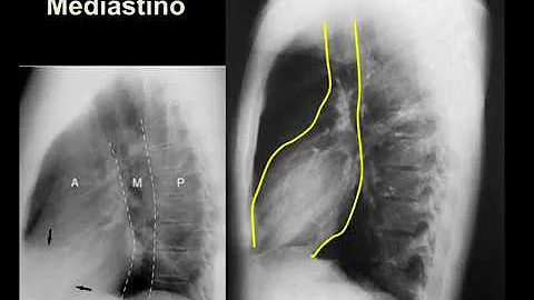 O que é massa no mediastino?