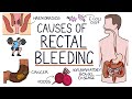 Understanding the Causes of Blood in Stool (Rectal Bleeding)