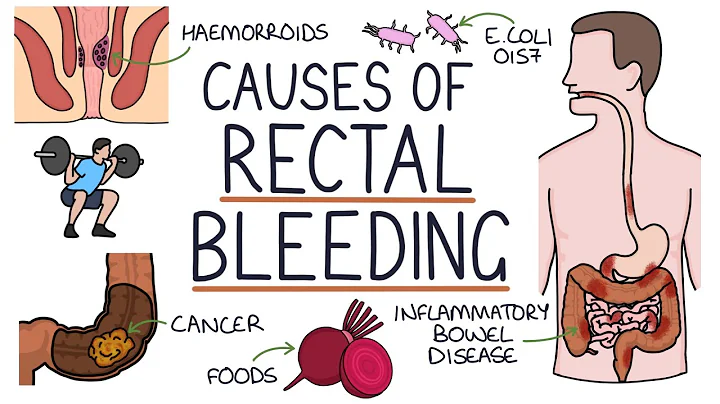Understanding the Causes of Blood in Stool (Rectal Bleeding) - DayDayNews