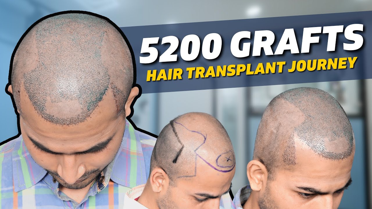 Hair Transplant in Bhubaneswar Best Results & Cost of Hair Transplant
