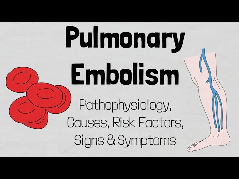 Pulmonary Embolism: Pathophysiology, Causes, Risk Factors, Signs & Symptoms.