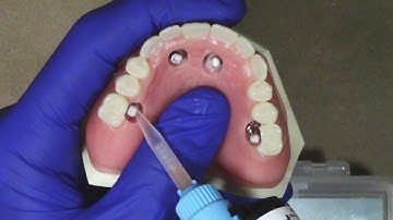 Technique Demonstration: All-on-4 Benchtop Conversion Using CHAIRSIDE Attachment Processing Material